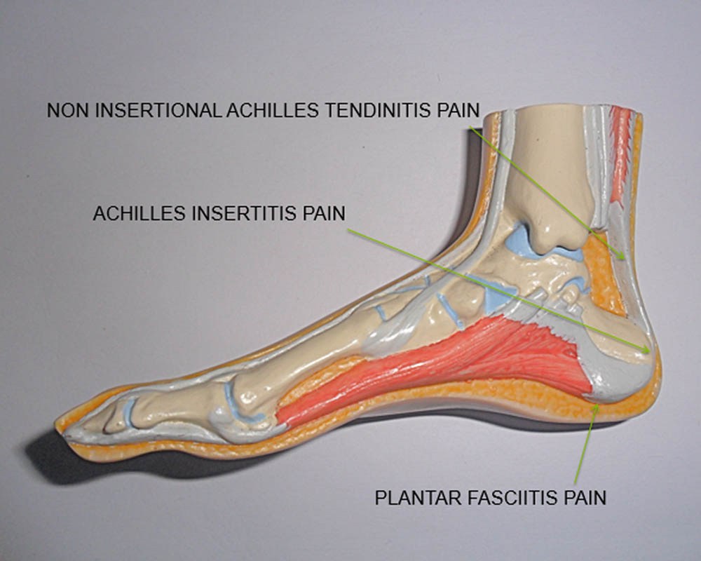 Heel Pain Image