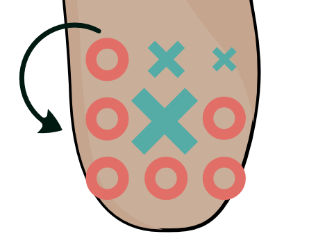 What Is Fat Pad Atrophy?