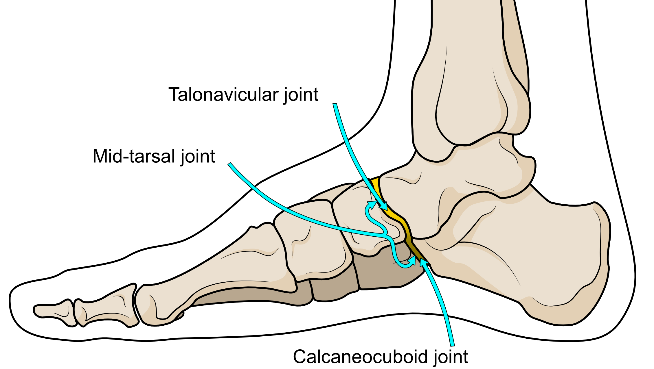Why The Talonavicular Joint Really Matters! Insoles and Orthotics