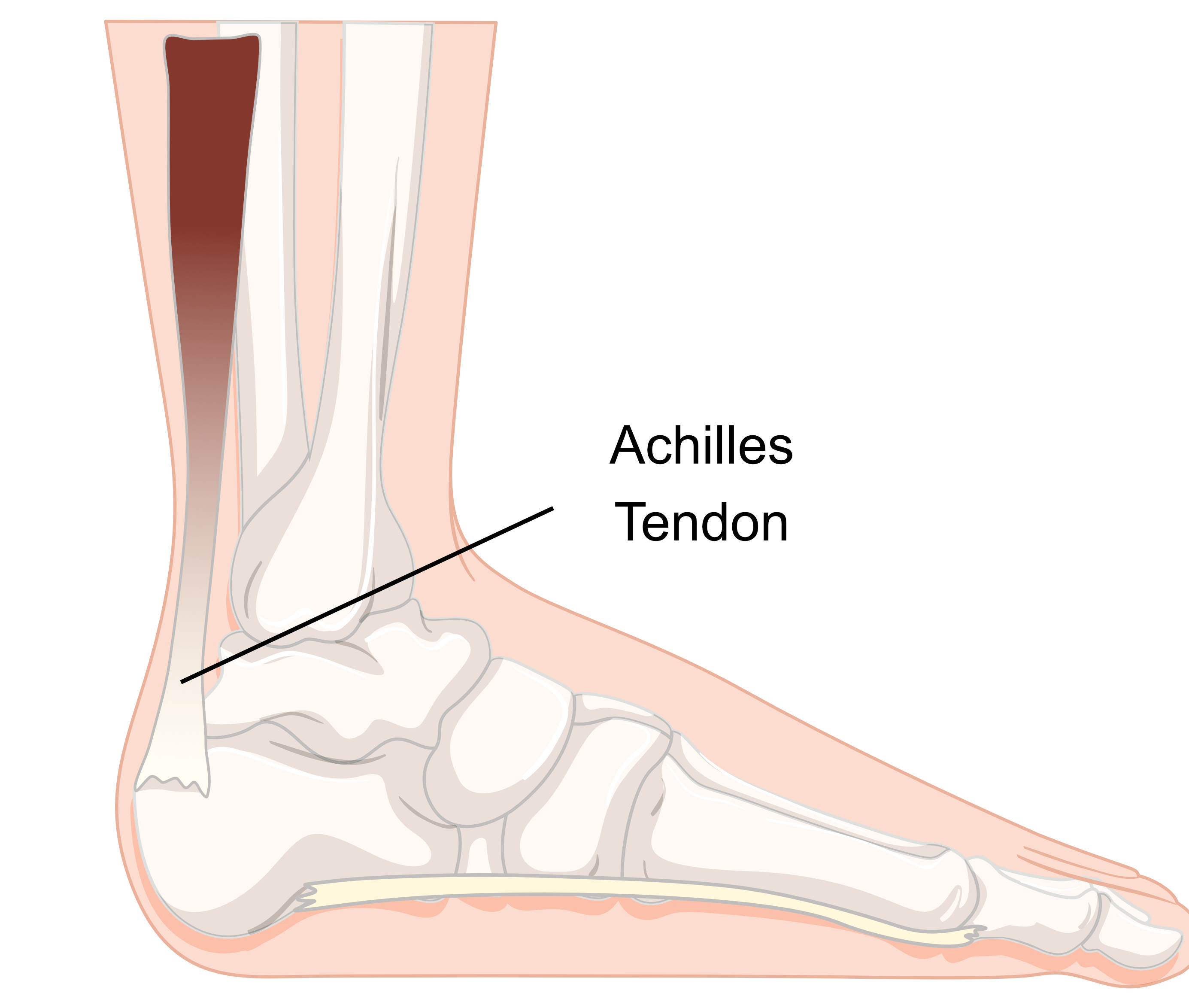 What is Achilles Tendinopathy Insoles and Orthotics Healthy Step