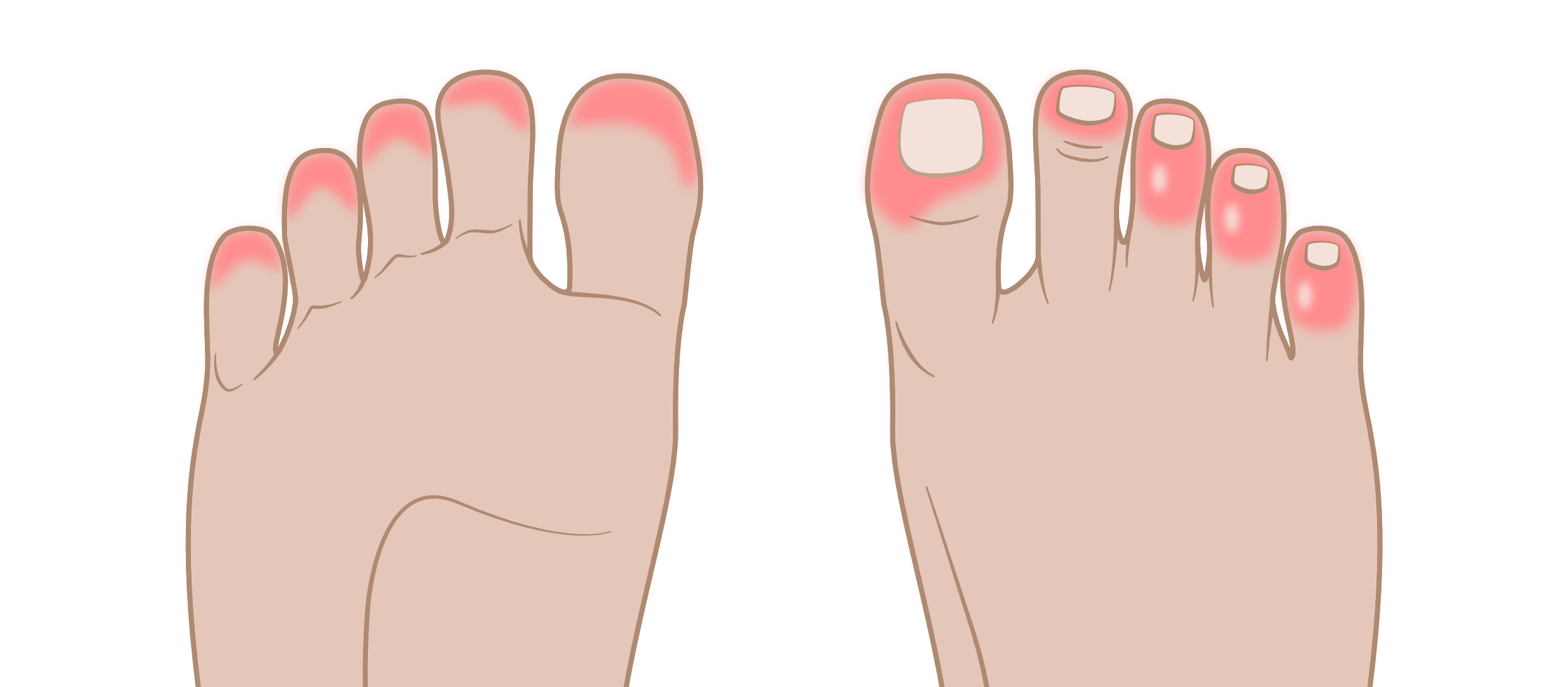 Covid Toes and How To Help Avoid Them - Insoles and Orthotics - Healthy Step