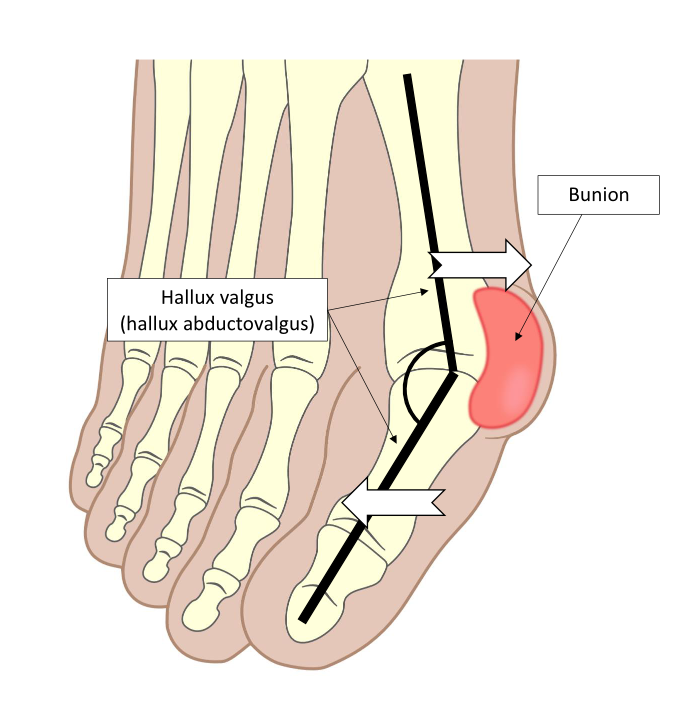 Hallux valgus, the ganglion on the big toe: Conservative treatment or  surgery?